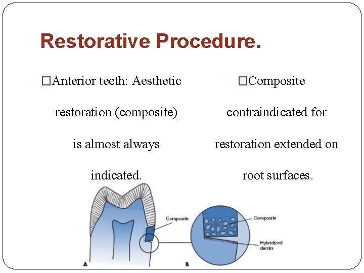 Restorative Procedure. �Anterior teeth: Aesthetic �Composite restoration (composite) contraindicated for is almost always restoration
