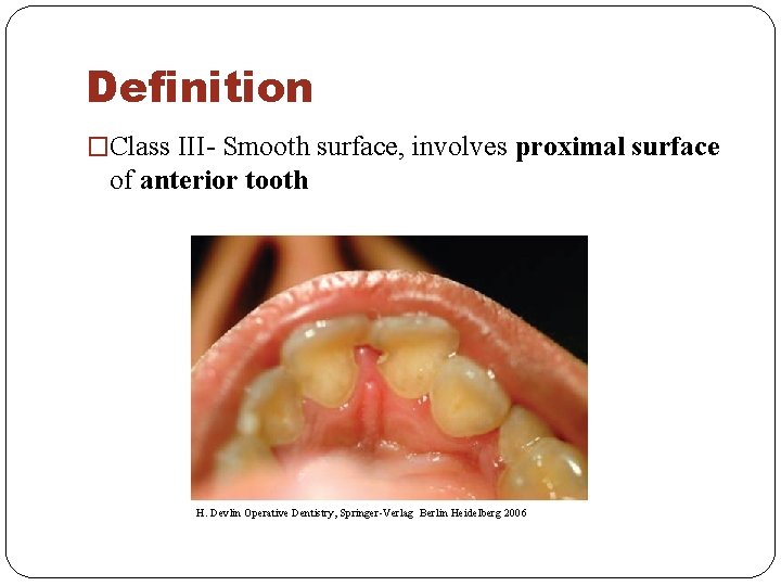 Definition �Class III- Smooth surface, involves proximal surface of anterior tooth H. Devlin Operative