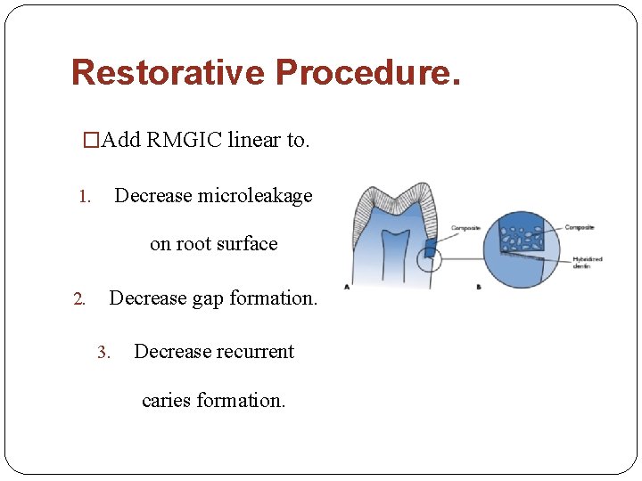Restorative Procedure. �Add RMGIC linear to. Decrease microleakage 1. on root surface 2. Decrease