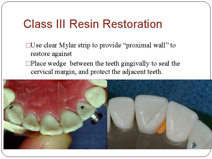 Class III Resin Restoration �Use clear Mylar strip to provide “proximal wall” to restore