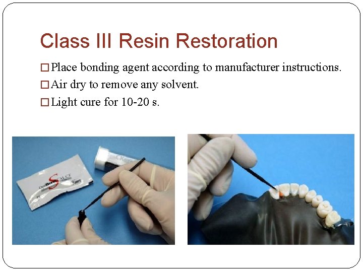 Class III Resin Restoration � Place bonding agent according to manufacturer instructions. � Air