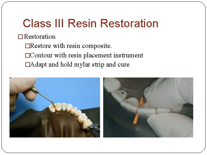 Class III Resin Restoration �Restore with resin composite. �Contour with resin placement instrument �Adapt
