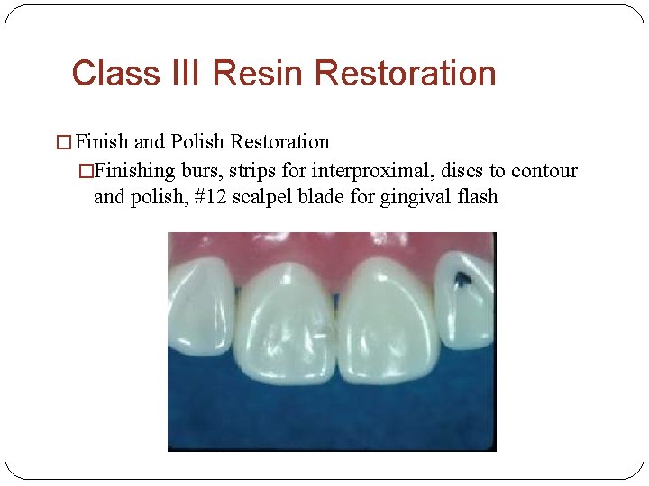 Class III Resin Restoration � Finish and Polish Restoration �Finishing burs, strips for interproximal,