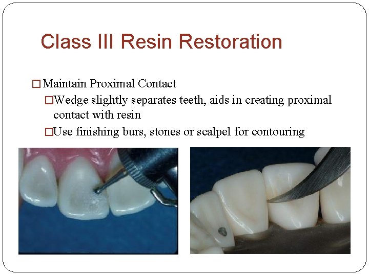 Class III Resin Restoration � Maintain Proximal Contact �Wedge slightly separates teeth, aids in