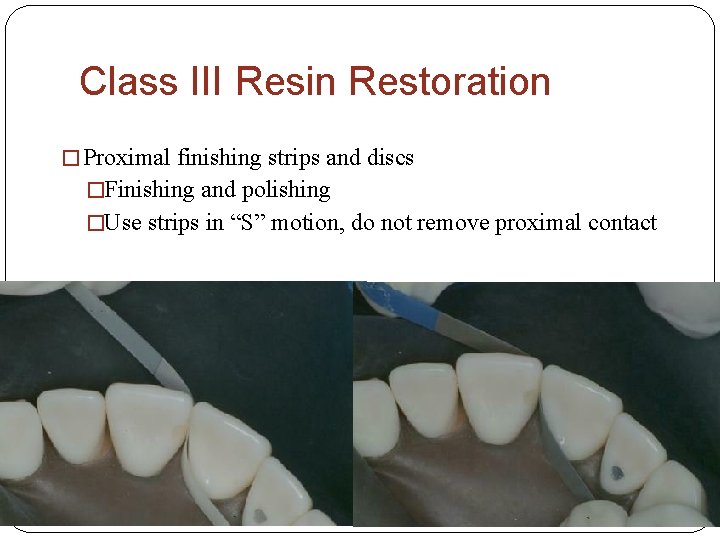 Class III Resin Restoration � Proximal finishing strips and discs �Finishing and polishing �Use