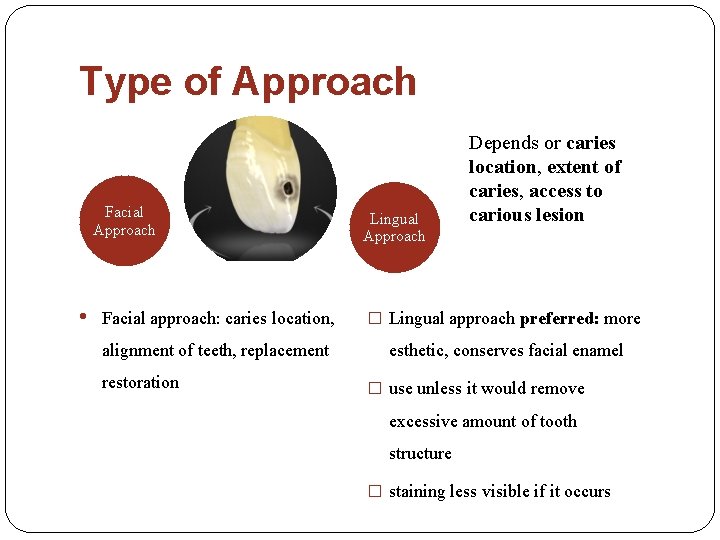Type of Approach Facial Approach • Lingual Approach Depends or caries location, extent of