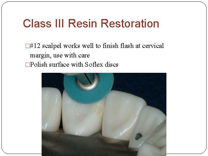 Class III Resin Restoration �#12 scalpel works well to finish flash at cervical margin,