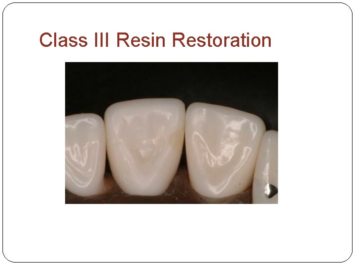 Class III Resin Restoration 