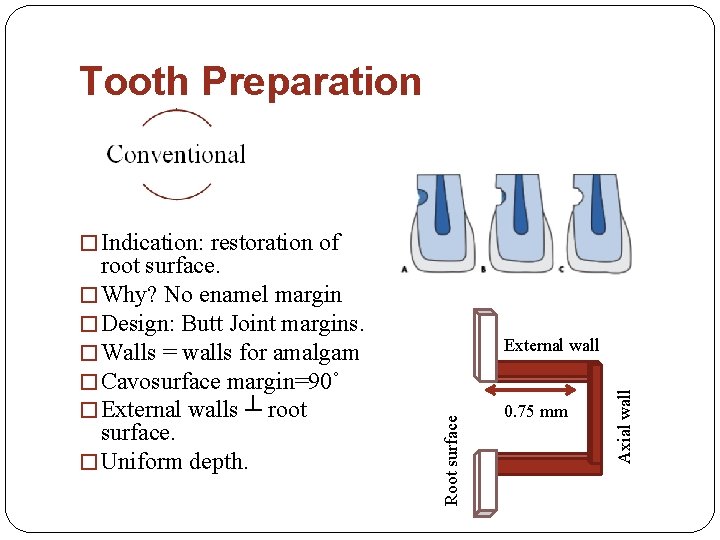 Tooth Preparation � Indication: restoration of 0. 75 mm Axial wall External wall Root