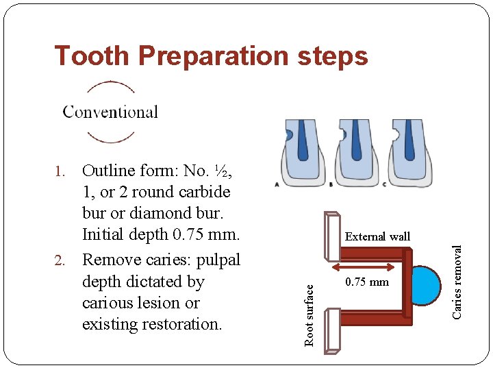 Tooth Preparation steps Outline form: No. ½, 1, or 2 round carbide bur or