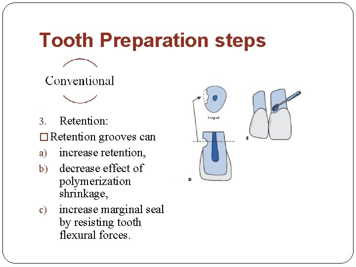 Tooth Preparation steps Retention: � Retention grooves can a) increase retention, b) decrease effect