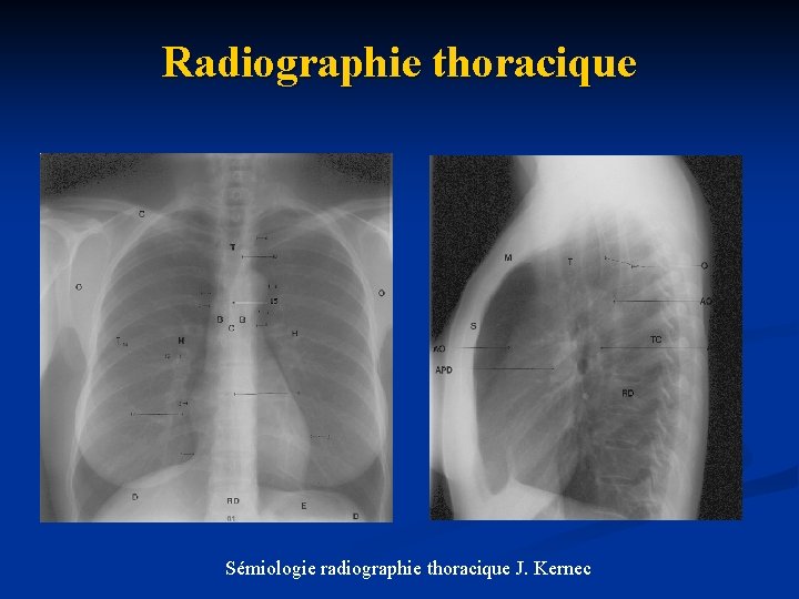 Radiographie thoracique Sémiologie radiographie thoracique J. Kernec 