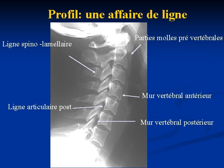 Profil: une affaire de ligne Ligne spino -lamellaire Parties molles pré vertébrales C 4