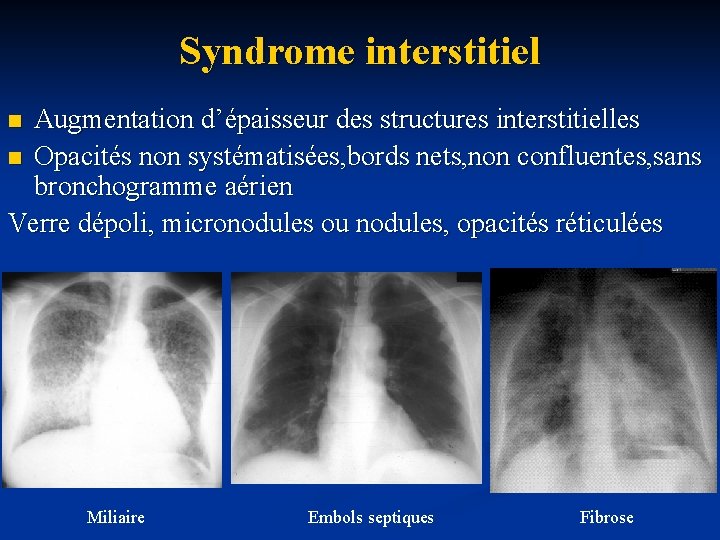 Syndrome interstitiel Augmentation d’épaisseur des structures interstitielles n Opacités non systématisées, bords nets, non