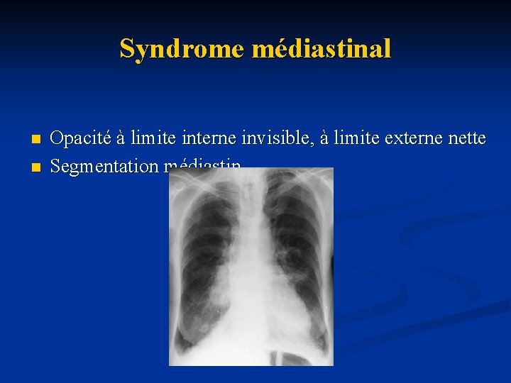 Syndrome médiastinal n n Opacité à limite interne invisible, à limite externe nette Segmentation