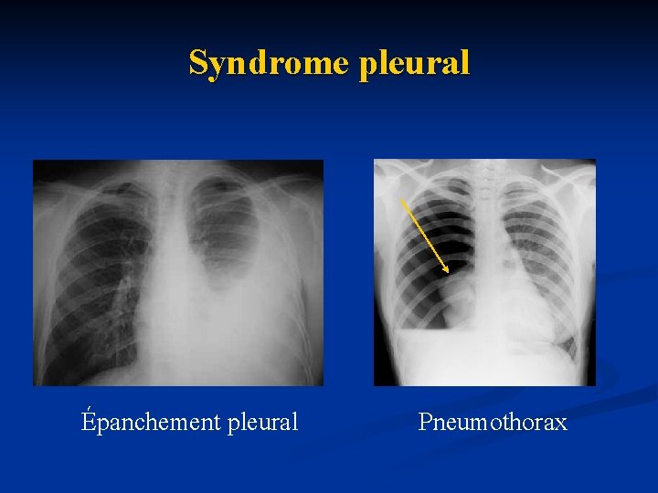 Syndrome pleural Épanchement pleural Pneumothorax 