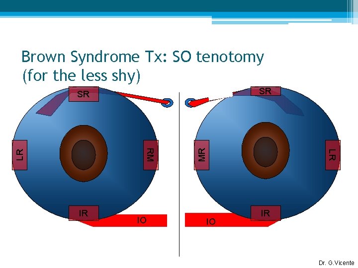 Brown Syndrome Tx: SO tenotomy (for the less shy) SR IO IO LR LR