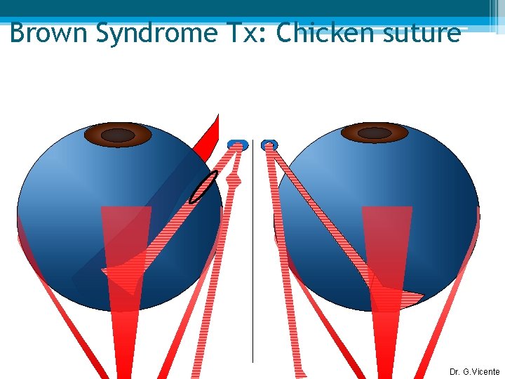 Brown Syndrome Tx: Chicken suture Dr. G. Vicente 