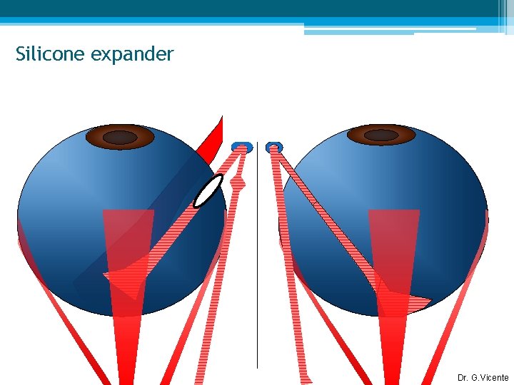 Silicone expander Dr. G. Vicente 