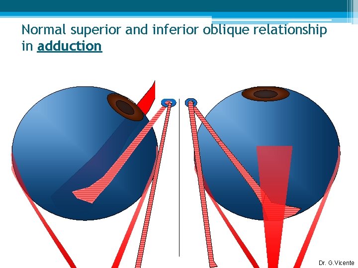 Normal superior and inferior oblique relationship in adduction Dr. G. Vicente 