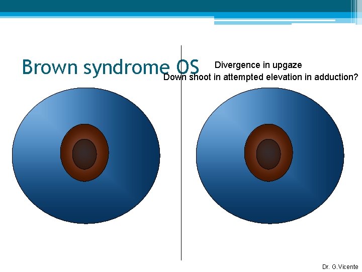 Divergence in upgaze Brown syndrome. Down OS shoot in attempted elevation in adduction? Dr.