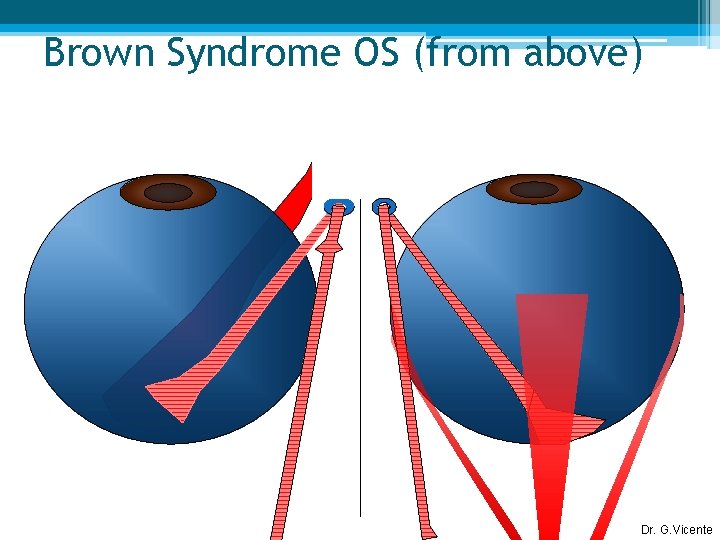 Brown Syndrome OS (from above) Dr. G. Vicente 