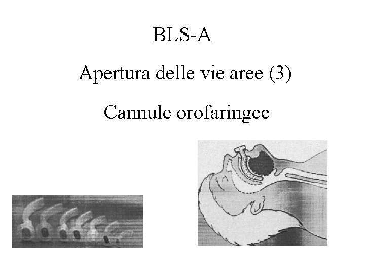 BLS-A Apertura delle vie aree (3) Cannule orofaringee 