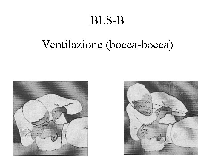 BLS-B Ventilazione (bocca-bocca) 