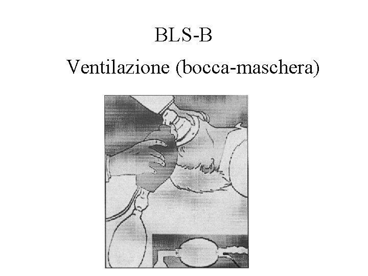 BLS-B Ventilazione (bocca-maschera) 