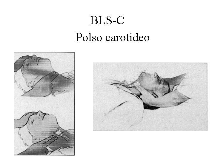 BLS-C Polso carotideo 