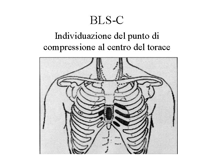 BLS-C Individuazione del punto di compressione al centro del torace 