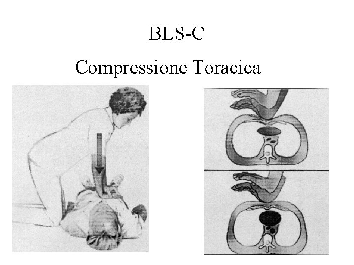 BLS-C Compressione Toracica 