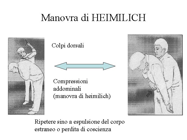 Manovra di HEIMILICH Colpi dorsali Compressioni addominali (manovra di heimilich) Ripetere sino a espulsione