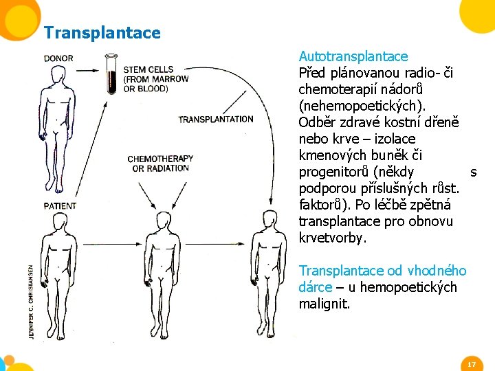 Transplantace Autotransplantace Před plánovanou radio- či chemoterapií nádorů (nehemopoetických). Odběr zdravé kostní dřeně nebo