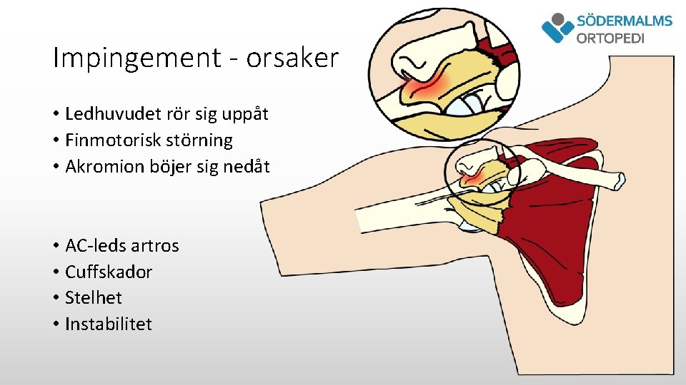 Impingement - orsaker • Ledhuvudet rör sig uppåt • Finmotorisk störning • Akromion böjer