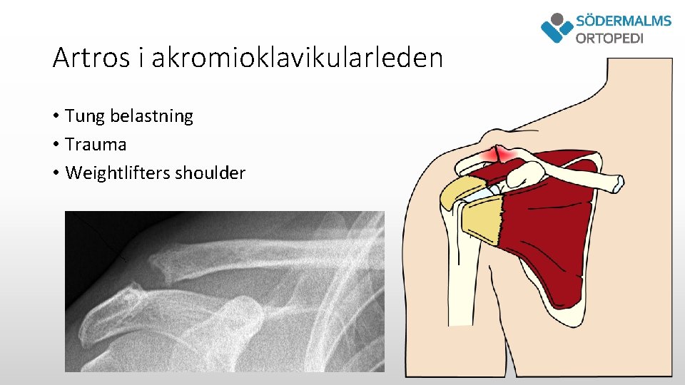 Artros i akromioklavikularleden • Tung belastning • Trauma • Weightlifters shoulder 