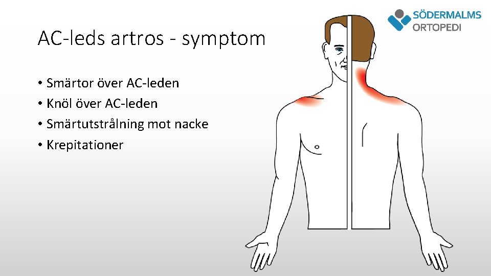 AC-leds artros - symptom • Smärtor över AC-leden • Knöl över AC-leden • Smärtutstrålning