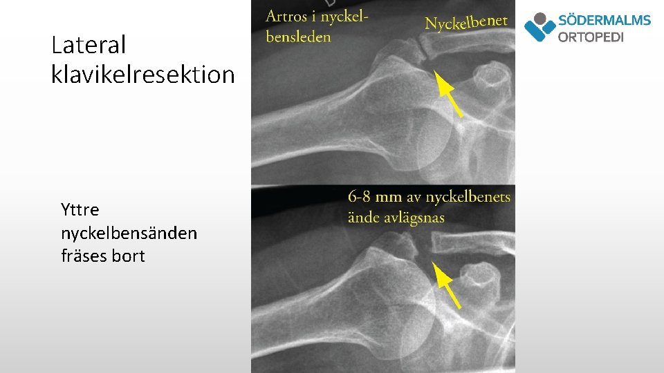 Lateral klavikelresektion Yttre nyckelbensänden fräses bort 