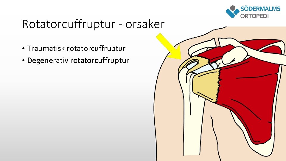 Rotatorcuffruptur - orsaker • Traumatisk rotatorcuffruptur • Degenerativ rotatorcuffruptur 