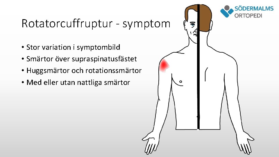 Rotatorcuffruptur - symptom • Stor variation i symptombild • Smärtor över supraspinatusfästet • Huggsmärtor