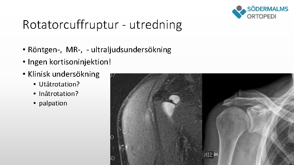 Rotatorcuffruptur - utredning • Röntgen-, MR-, - ultraljudsundersökning • Ingen kortisoninjektion! • Klinisk undersökning