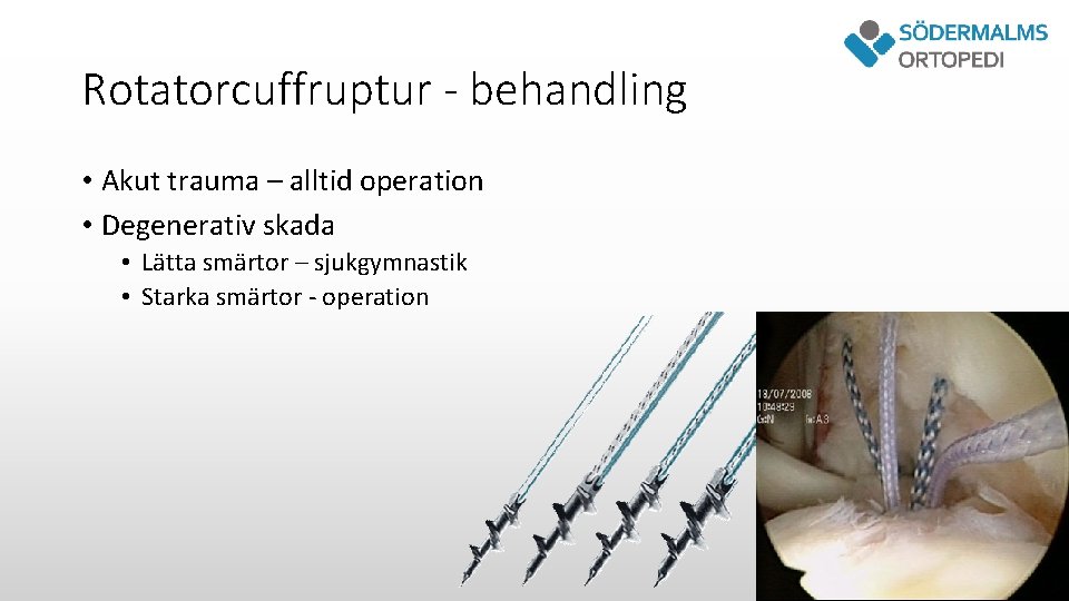 Rotatorcuffruptur - behandling • Akut trauma – alltid operation • Degenerativ skada • Lätta
