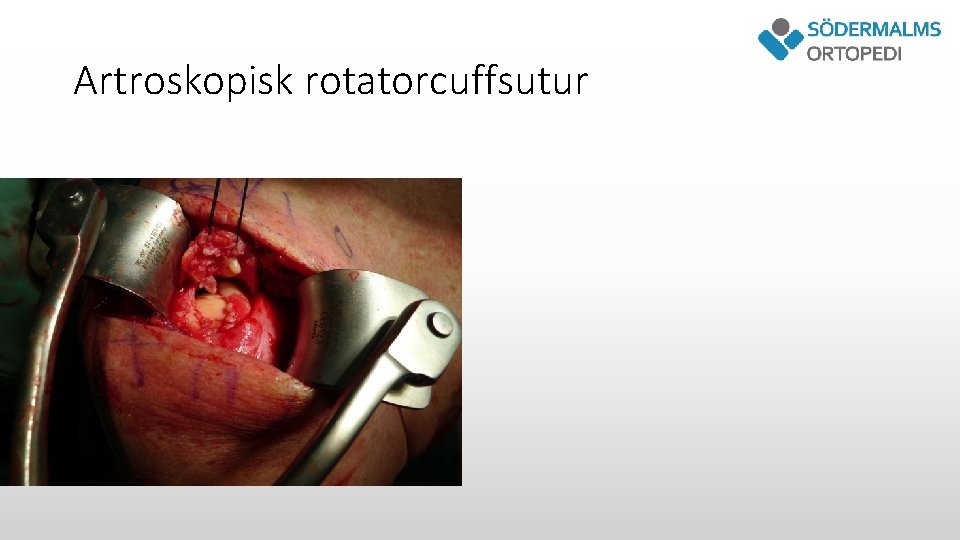Artroskopisk rotatorcuffsutur 