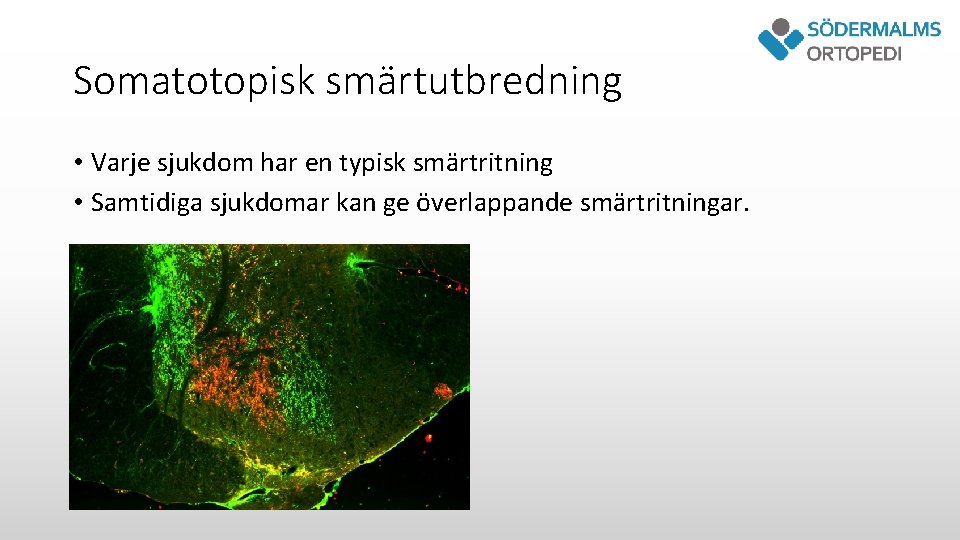 Somatotopisk smärtutbredning • Varje sjukdom har en typisk smärtritning • Samtidiga sjukdomar kan ge
