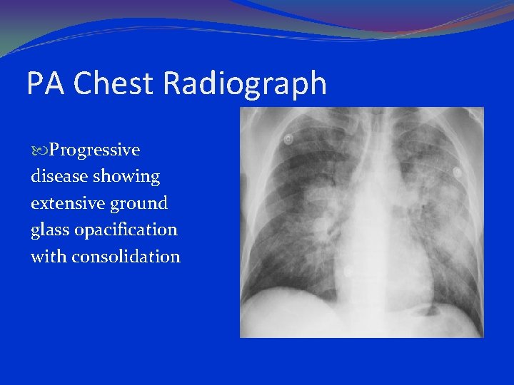 PA Chest Radiograph Progressive disease showing extensive ground glass opacification with consolidation 