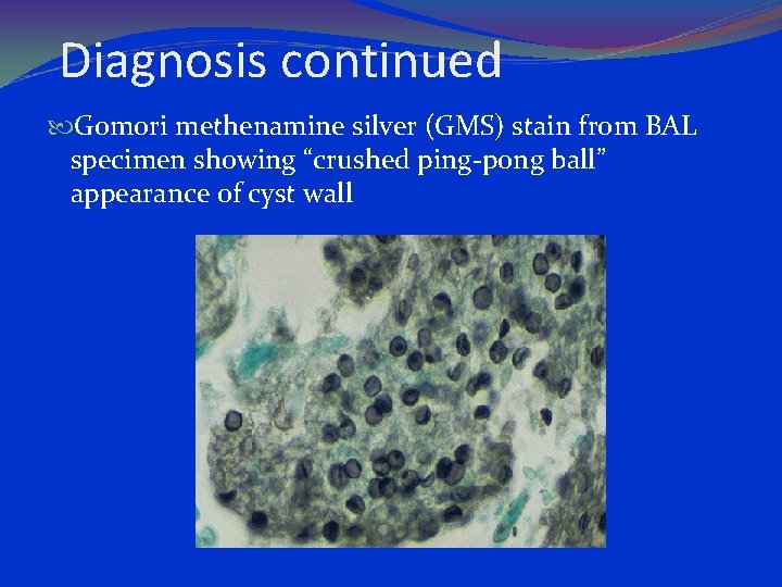 Diagnosis continued Gomori methenamine silver (GMS) stain from BAL specimen showing “crushed ping-pong ball”