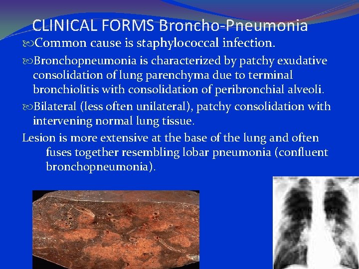 CLINICAL FORMS Broncho-Pneumonia Common cause is staphylococcal infection. Bronchopneumonia is characterized by patchy exudative