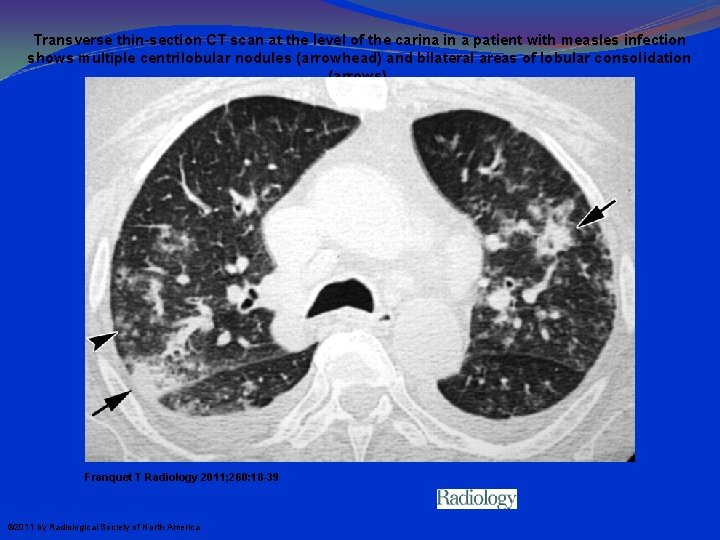 Transverse thin-section CT scan at the level of the carina in a patient with