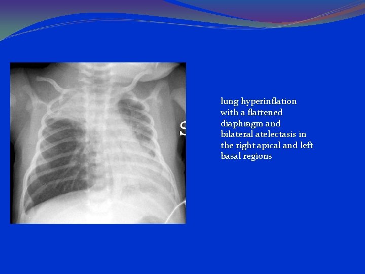 lung hyperinflation with a flattened diaphragm and bilateral atelectasis in the right apical and