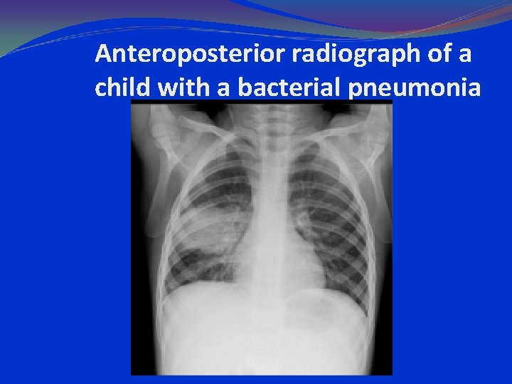 Anteroposterior radiograph of a child with a bacterial pneumonia 